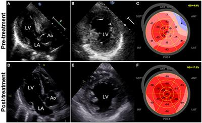 The Diagnostic Challenge of Eosinophilic Granulomatosis With Polyangiitis Presenting as Acute Eosinophilic Myocarditis: Case Report and Literature Review